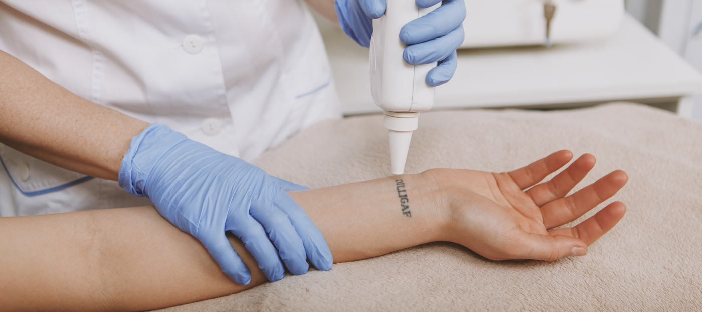 Your Complete Guide to Tattoo Removal | Allure